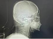 Un hombre vivió 8 años con un palillo de metal atascado en la garganta