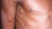 OMS alerta del riesgo de transmisión comunitaria de mpox a menos que se contengan rápidamente los brotes existentes