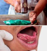 Investigan vínculo entre coca y más de 40 casos de cáncer bucal