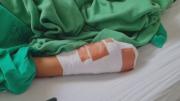 Niño de 9 años que perdió dedos por explosivo requiere dos operaciones