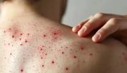 Perú emite alerta epidemiológica por alto riesgo de diseminación de sarampión en el país