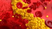 Colesterol alto: las cifras que realmente alertan sobre un riesgo cardiovascular