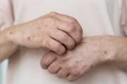 Ministerio de Salud recomienda reconocer síntomas y signos para prevenir el sarampión