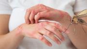 Guarayos: En cinco viviendas encuentran flebótomo, insecto transmisor de la leishmaniasis