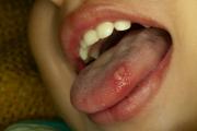 Potosí reporta 27 casos de herpangina en unidades educativas y activa acciones para frenar los contagios