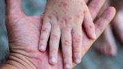 SEDES activa rastrillaje por casos de virus Coxsackie en Potosí